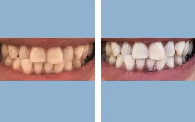 Before and After